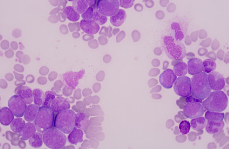 Tweedaagse verdiepingscursus Chronische Leukemie